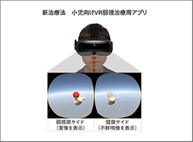 片眼性の弱視　VRゲームで遊びながら治療する時代へ