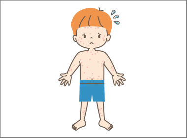 デュピクセントの小児アトピー性皮膚炎適応　処方増意向は９割弱